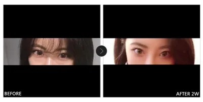 [Babytalk 心得] 眼底脂肪重置 第2週 / 暱稱：梅伊拉