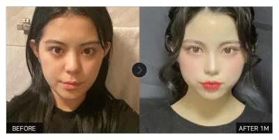 [江南姐姐 心得] 面部脂肪填充滿一個月 / 暱稱：담공마인두