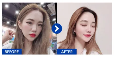 [Babitalk] 隆鼻 / 術後5個月 / 暱稱：둉둉이잉