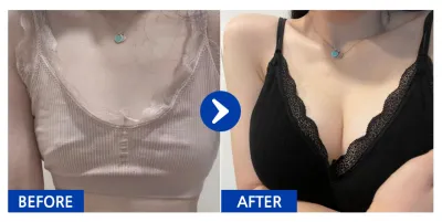 [江南姐姐] 隆乳 (賽彬) / 第3個月 / 暱稱：횬니횬니