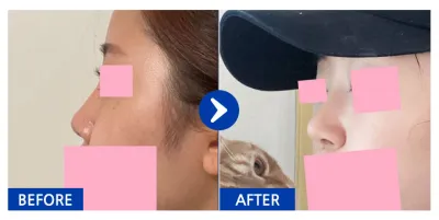 [江南姐姐] 鼻整形 / 第2個月 / 暱稱：젤리리리릴