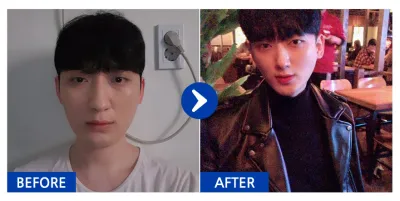 [江南姐姐] 隆鼻 / 第4個月 / 暱稱：核奎