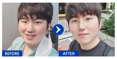 [江南姐姐] 鼻整形 / 第5個月 / 暱稱：본주로남