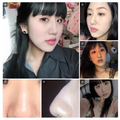 [Babitalk] 隆鼻 / 1個月 / 暱稱：金敏智1111