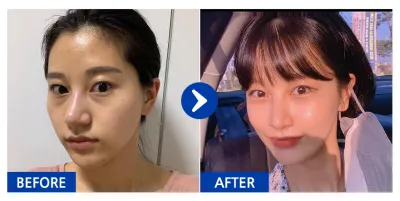 [Babitalk] 脂肪移植 / 第5個月 / 暱稱：아멜리칼노