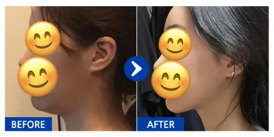 [Babitalk] 臉部抽脂 / 術後1個月 / 暱稱：바비톡히