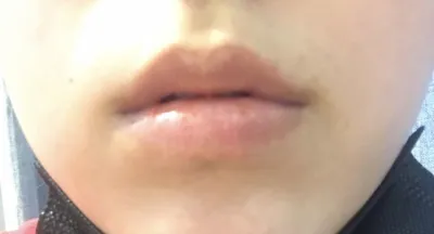 [微整形] 뭉치짜으릉 - 填充劑