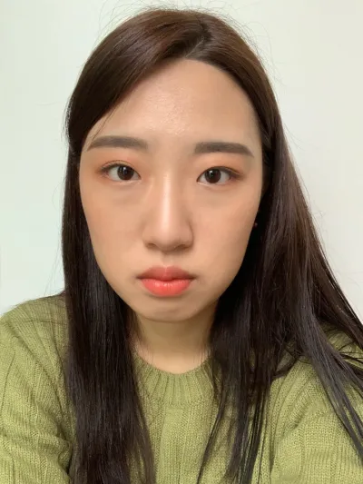 [眼部] 閃亮亮 - 非切開眼瞼下垂矯正、開眼頭、眼下脂肪重新配置