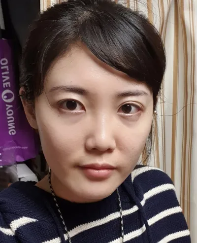 [眼部] 肯定 - 切開雙眼皮重修手術