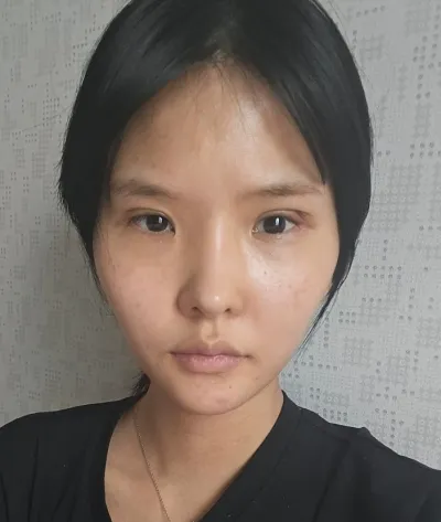 [眼睛] 薄荷巧克力黨 - 切開式眼瞼下垂矯正、開眼頭、開眼尾、下眼瞼下至 重修手術