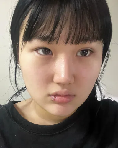 [眼睛] 灰色香蕉 - 切開式雙眼皮重修手術，開眼頭