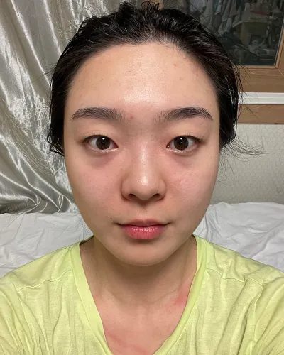 [眼部] Pan Panda - 眼下脂肪重新配置