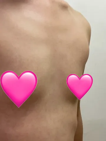 [隆胸] 네모빔 - 胸部