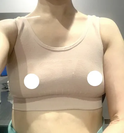 [隆胸] 玉順 - 隆胸