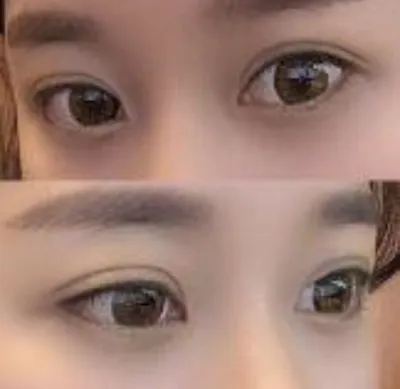 [眼睛] 去賞花吧 - 眼型矯正