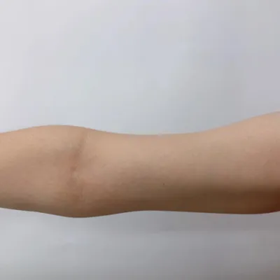 [抽脂] Hot Summer Summer - 手臂溶脂針