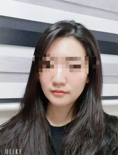 [微整] [準會員ngR5DA2] - 音波拉提、肉毒桿菌