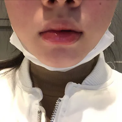 [微整] 뀨꺙팡이 - 嘴唇填充