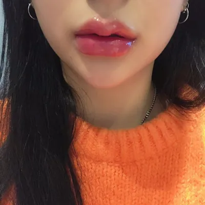 [微整形] naaa_ - 填充劑