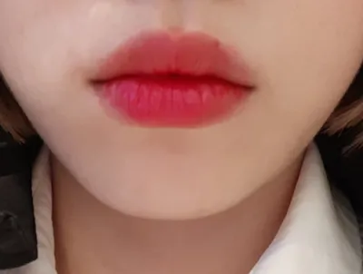 [微整形] Diarupa - 填充劑、肉毒桿菌