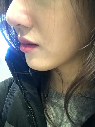 [微整形] si123 - 鼻雕塑注射