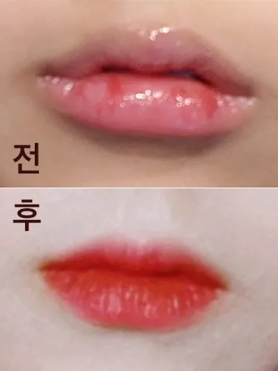 [微整形] 豐唇 - 填充劑、肉毒桿菌