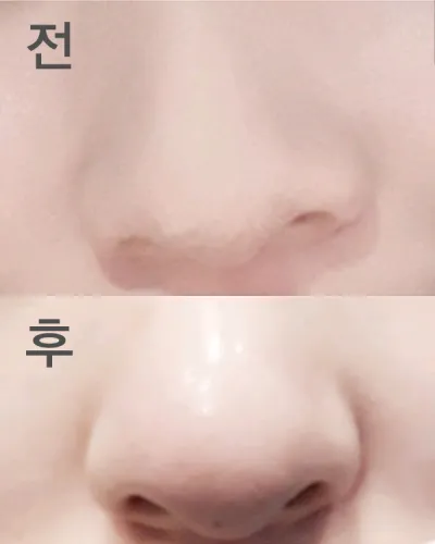 [微整形] 쁘루 - 鼻雕塑注射