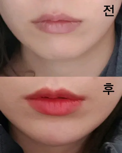 [微整形] 豐滿 - 下巴填充劑、肉毒桿菌