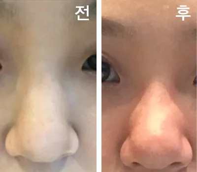 [微整] 뀨잉3535 - 鼻雕塑注射