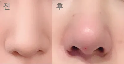 [微整形] tanatana0 - 鼻雕塑注射