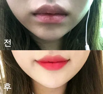 [微整形] 콘크롱이 - 嘴唇填充