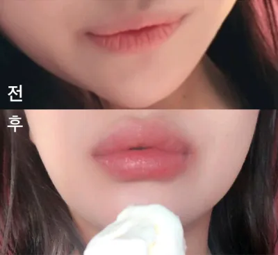 [微整] bkbkbk - 嘴唇填充