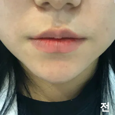 [微整形] 豆豆露呀 - 嘴唇填充、肉毒桿菌