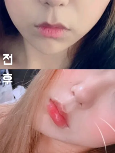 [微整形] Chichi Ke - 嘴唇填充