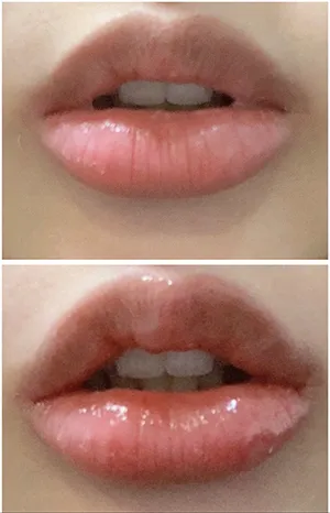 [微整形] 尹素利美 - 嘴唇