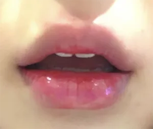 [微整形] titi - 嘴唇