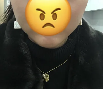 [微整形] Minjani - 肉毒桿菌, 下巴填充