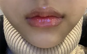 [微整形] 嘴唇填充