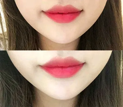 [微整] amslam - 嘴唇填充