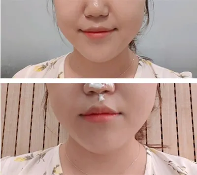 [皮膚] 돗特努里 - 埋線拉提、舒顏萃