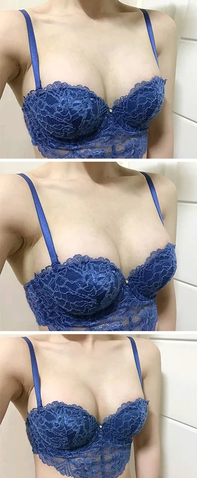 [隆胸] ekehae - 胸部