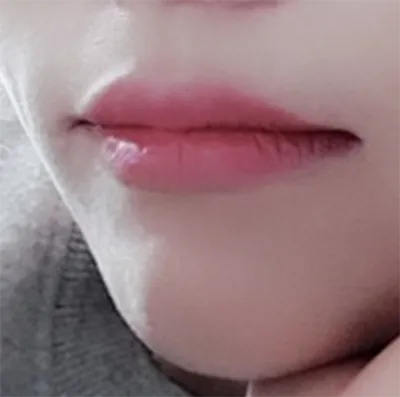 [微整] 夢遊仙境 - 嘴唇