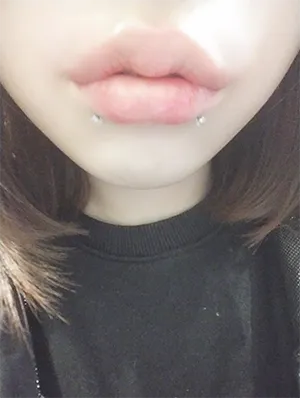 [微整形] 125688 - 嘴唇