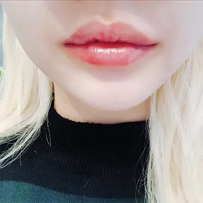 [微整形] 高美00 - 嘴唇