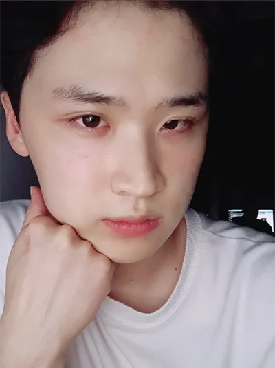 [男性] 小狗眼 - 眼部整形