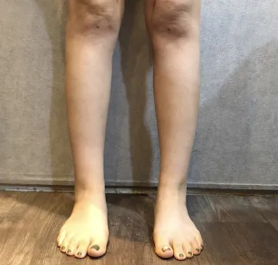 [抽脂] 如星星般飛舞吧 - 小腿、腹部抽脂