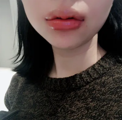 [微整形] 嘟嘟唇 - 嘴唇