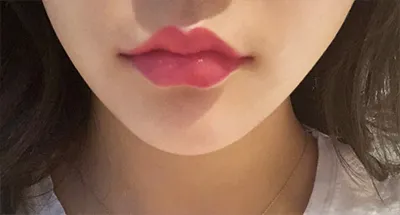 [微整] 呀吼 - 嘴唇