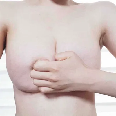 [隆胸] 西瓜般豐滿的小腿 - 隆胸