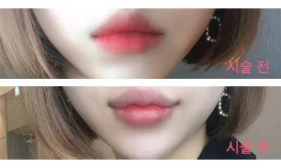 [微整] 變美吧 - 豐唇